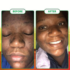 Organic African Soap for Acne & Dark Spots - 2 Bars x 65g Each