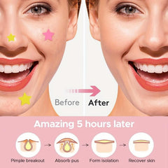 Acne Patch Pimple Patch Yellow Star Shaped Acne Absorbing Cover Patch