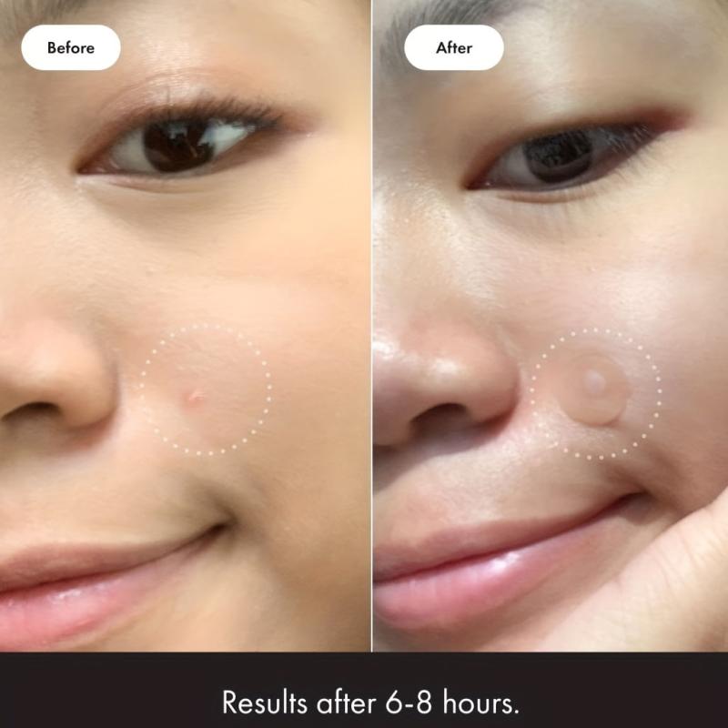 108pcs Acne Patches Hydrocolloid Spot Stickers for Face Skin