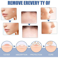 144pc Hydrocolloid Acne Pimple Patches for Face & Skin