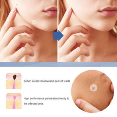 144pc Hydrocolloid Acne Pimple Patches for Face & Skin