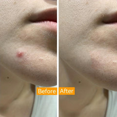 Halloween Pumpkin Pimple Patches for Face Blemishes
