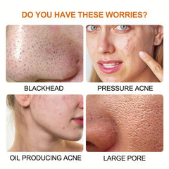 Hydrocolloid Acne Patches For Pimple Zit Patch