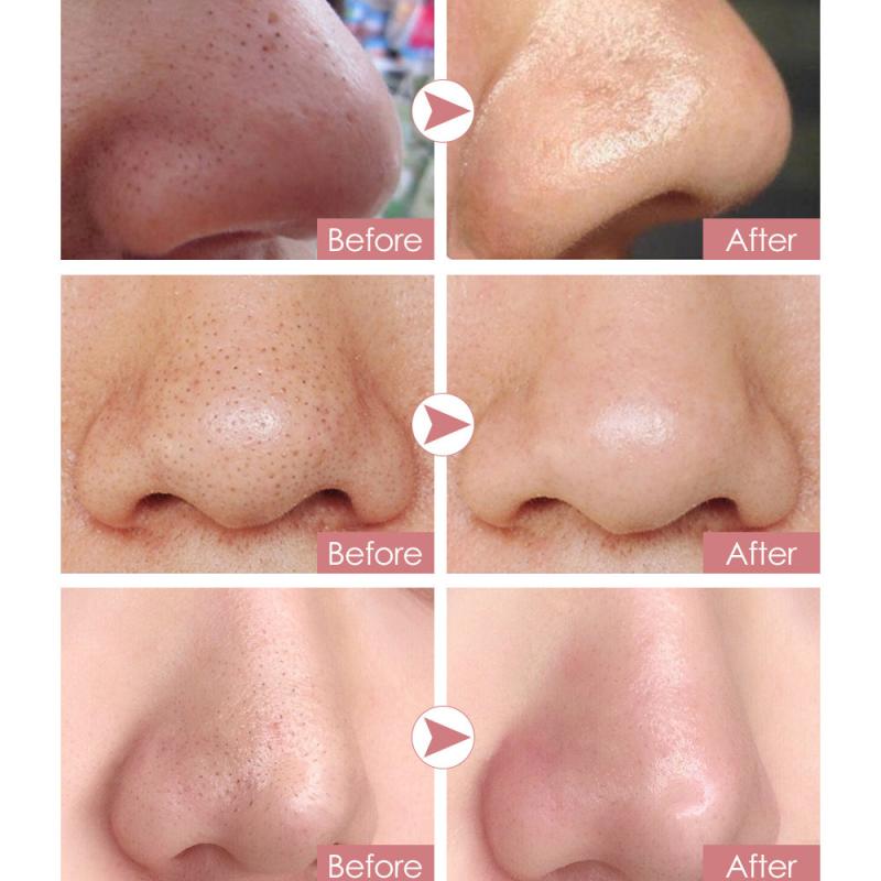10pcs Blackhead Nose Strips with Calendula - Pore Refining Skin Care