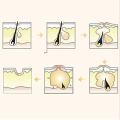 5 Pack Invisible Waterproof Acne Patch Hydrocolloid Concealer