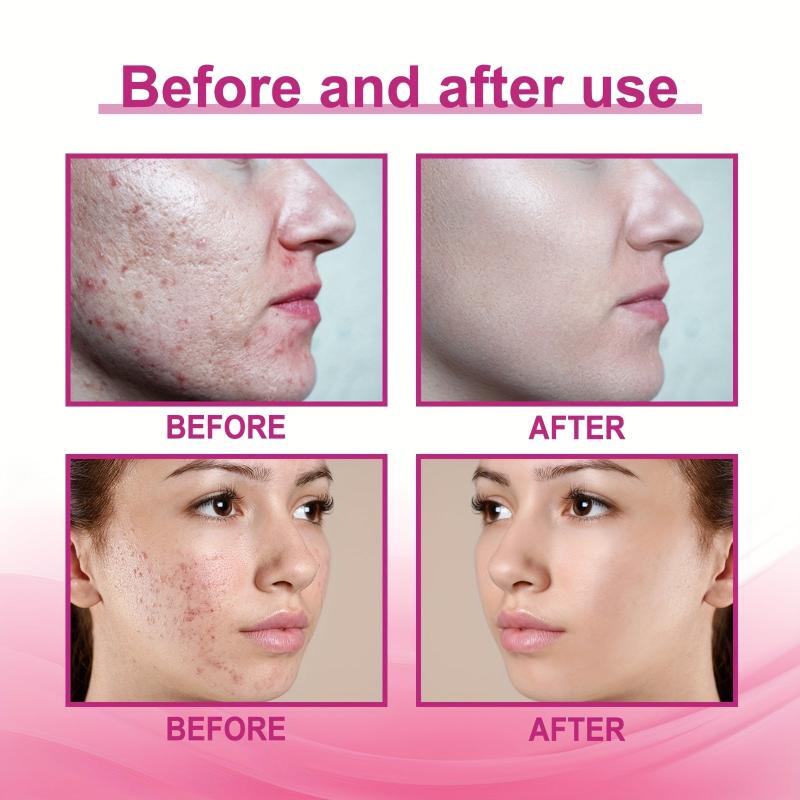 Invisible Acne Patch Breathable Concealer Clean Repair Acne Patch