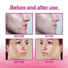 Invisible Acne Patch Breathable Concealer Clean Repair Acne Patch