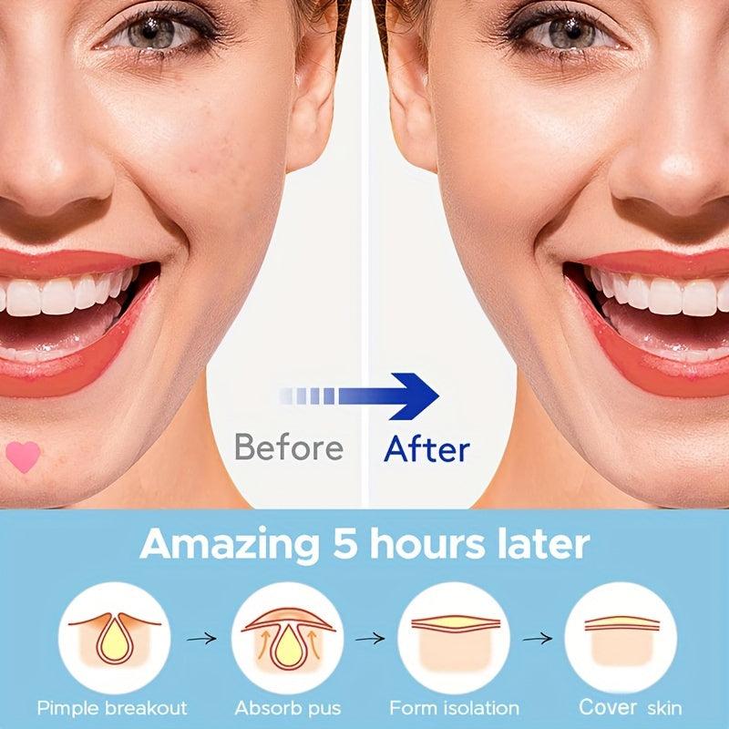 Acne Patch Pimple Patch Pink Heart Shaped Hydrocolloid Acne Patches