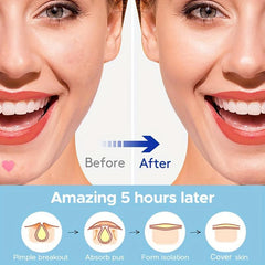 Acne Patch Pimple Patch Pink Heart Shaped Hydrocolloid Acne Patches