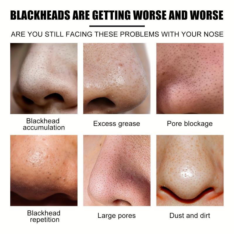 Blackhead Stickers Deep Cleansing Nose Blackhead Acne Tight And Delicate Pores