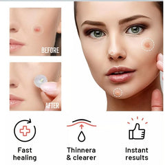Acne Pimple Patches Transparent Hydrocolloid Skin Care Facial Acne Patches 36pcs