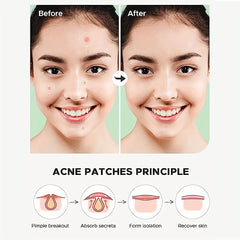 Acne Pimple Patches For Daily & Night Skin Care