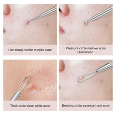 Stainless Steel Acne Clips Cell Clips Acne Needles - 5 Sets