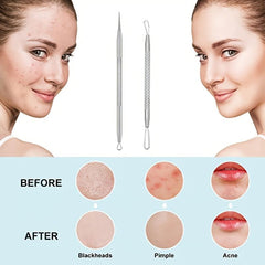 Stainless Steel Acne Clips Cell Clips Acne Needles - 5 Sets