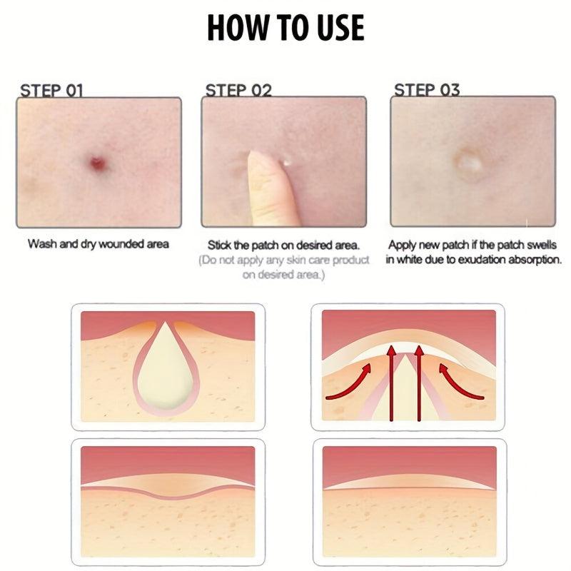 Invisible Acne Pimple Patches 36 180 Patches Reduce Blemishes Inflammation