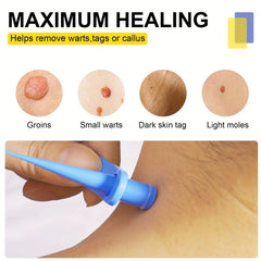 2-in-1 Wart & Acne Removal Kit - Fast & Effective Skin Tag Care