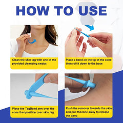 2-in-1 Wart & Acne Removal Kit - Fast & Effective Skin Tag Care