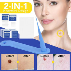 2-in-1 Wart & Acne Removal Kit - Fast & Effective Skin Tag Care