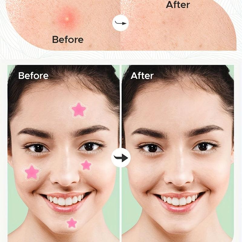 Pink Acne Pimple Patches Hydrocolloid Cover Blemish Spot Stickers 36pcs