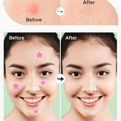 Acne Pimple Patches Hydrocolloid Rainbow Star Heart Shape 15pcs