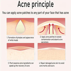 72pcs Invisible Acne Patch Tea Tree Essential Acne Removal