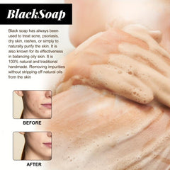Acne Repair Shea Butter Soap - Cleans Pores, Moisturizes, Smoothes Skin