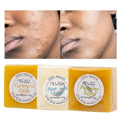 Turmeric Soap Bar for Acne Dark Spots Hyperpigmentation