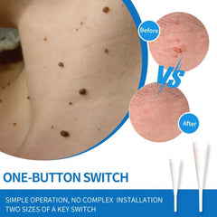 Auto Skin Tag Remover Kit - Safe and Painless Skin Tag Removal Device