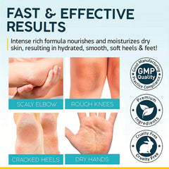 120ml Urea Cream 40% Strength Foot Lotion - Dry Cracked Feet