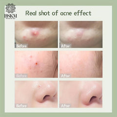 Night Tea Tree Acne Pimple Patch 22pcs