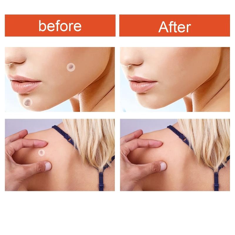 Skin Tag Acne Pimple Patch Blemish Spot Facial Mask Skin Care 120pcs