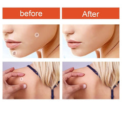 Skin Tag Acne Pimple Patch Blemish Spot Facial Mask Skin Care 120pcs