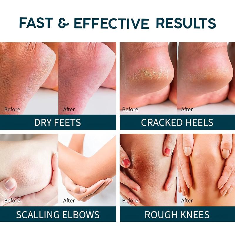 Urea Cream w/ 2% Salicylic Acid for Cracked Feet - Foot Moisturizer