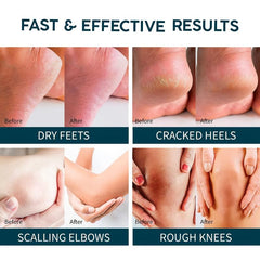 Urea Cream w/ 2% Salicylic Acid for Cracked Feet - Foot Moisturizer