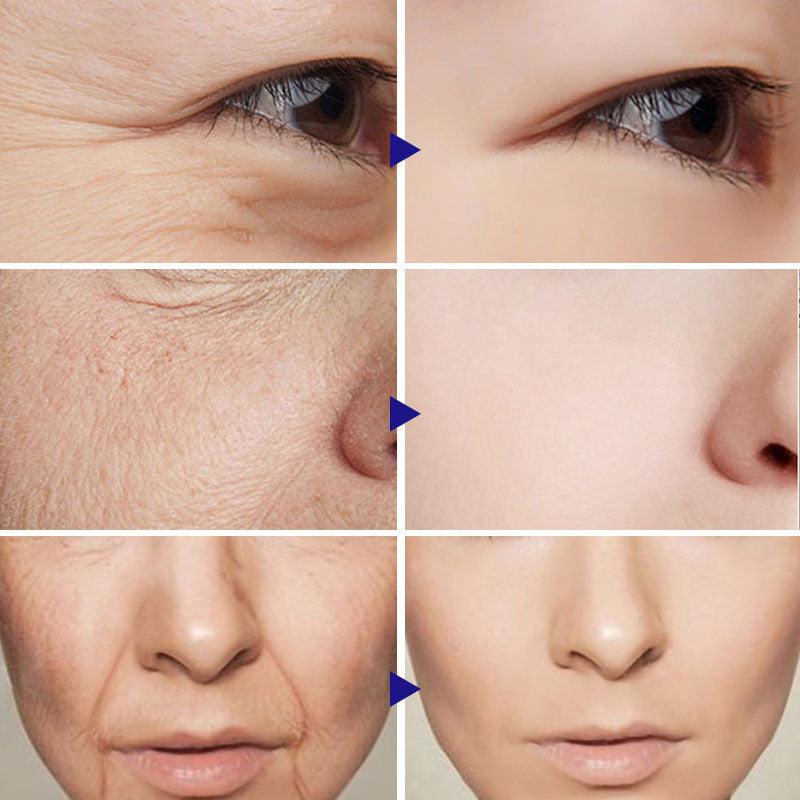 10Pcs Collagen Smile Line Patch For Facial Smile Line Lifting