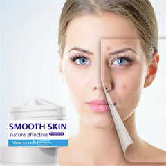 30ml Acne Removing Cream - Face Smoothing & Repairing