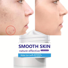 30ml Acne Removing Cream - Face Smoothing & Repairing
