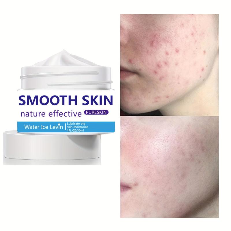 30ml Acne Removing Cream - Face Smoothing & Repairing