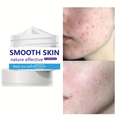 30ml Acne Removing Cream - Face Smoothing & Repairing