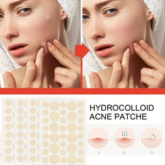 144pcs Acne Covering Patches for Daily & Night Skin Care