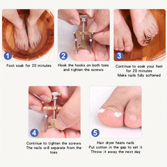 2Pcs Ingrown Toenail Protector Pedicure Tool Stainless Steel Foot Care