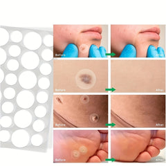 144PCS Skin Tag Remover Patches With Natural Ingredients