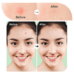 36 Ultra Thin Hydrogel Acne Patches 2 Sizes Waterproof Breathab