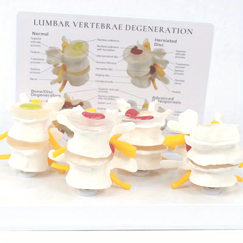 Lumbar Vertebrae Lesion Model Teaching Tool