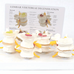 Lumbar Vertebrae Lesion Model Teaching Tool