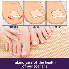 30pcs Toenail Corrector Patch Ingrown Toenail Corrector Sticker Nail Correction