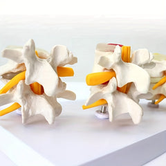 Lumbar Vertebrae Lesion Model Teaching Tool
