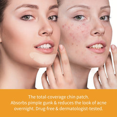 Hydrocolloid Acne Pimple Patch - Acne Cleansing Patch