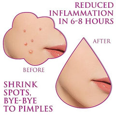 100Pcs Invisible Acne Removal Pimple Patch Butterfly Shape Beauty Tools