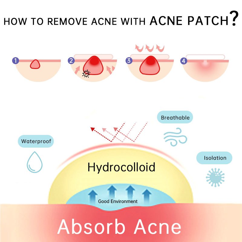 100Pcs Invisible Acne Removal Pimple Patch Butterfly Shape Beauty Tools
